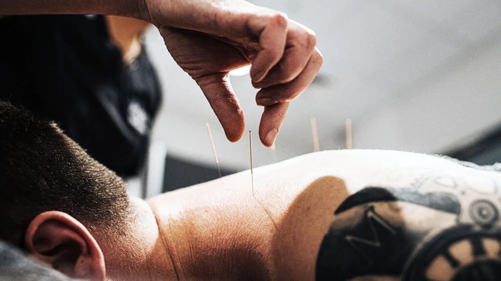 Physio performing acupuncture on a Patient