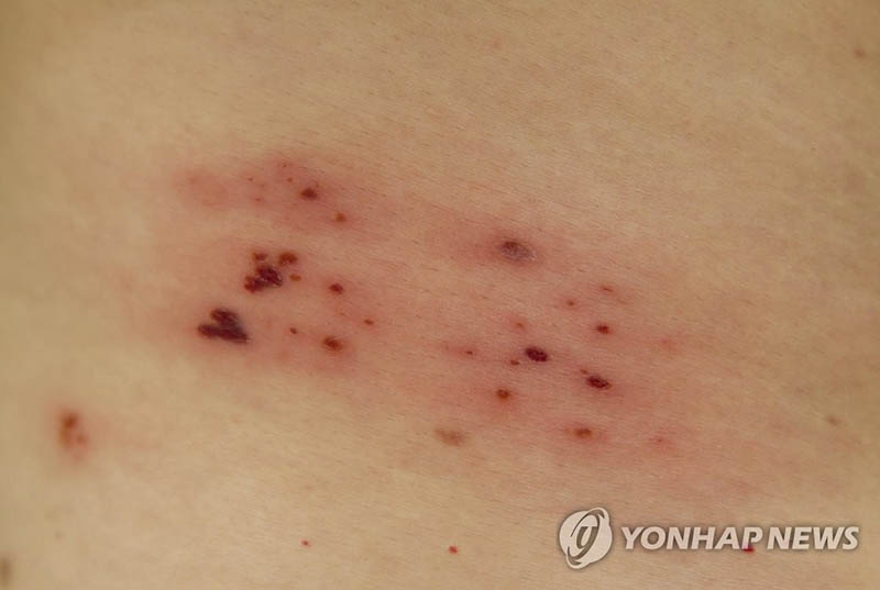 “장기 저용량 항바이러스 치료, 대상포진 통증·안질환에 효과”