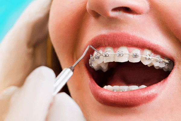 A young women has her mouth open showing her braces to an orthodontist who is examining them.