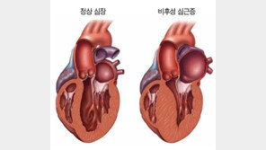 운동 중 지나치게 숨 차다면 비후성 심근병증 의심을[홍은심 기자의 긴가민가 질환시그널]