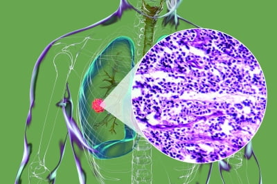 [테마 분석 ② STUDY] 레이저티닙이 걸어온 길, 비소세포폐암 치료에서의 EGFR TKI 개발 과정