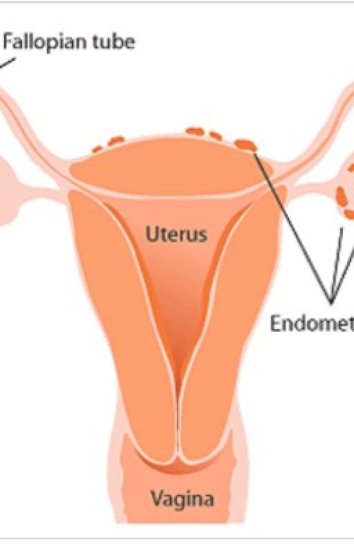 Living With Endometriosis  by jerriah15