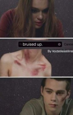 Bruised up | stydia au | teen wolf cover