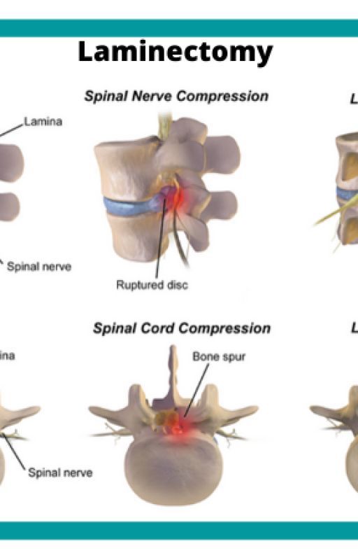 Spinal Decompression Surgery: Causes, Precautions, Treatment by TheNeurologist