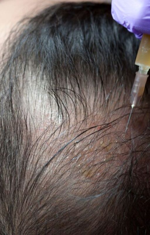 Everything You Need To Know About Hair Loss Treatment by Ainsley_View