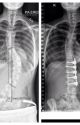 Having Scoliosis   Spinal Fusion Surgery by emotionalblip