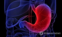  "위암 60%가 동아시아에 몰린 이유…가족력 영향 커"