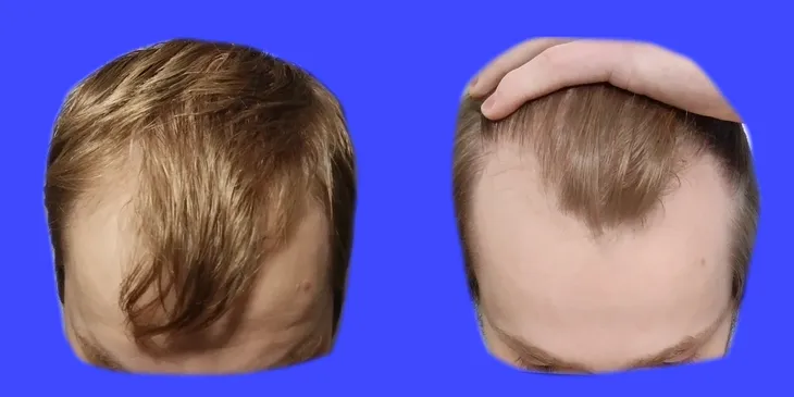 How to Fix Your Thinning Hair (Men Only)