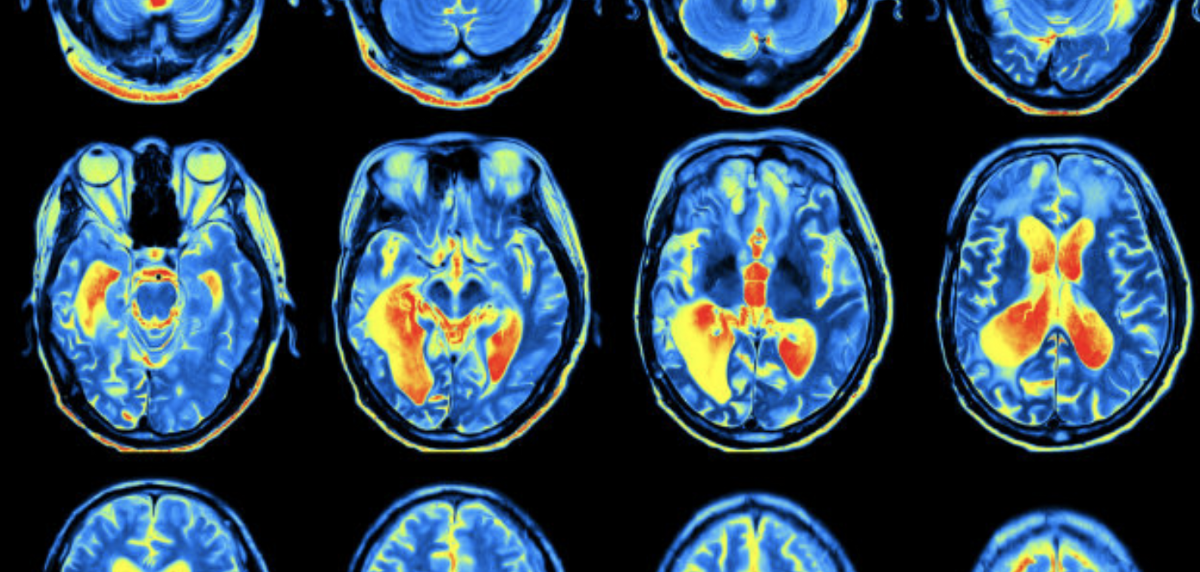 ADHD-Classification-with-Reliable-RELIEF