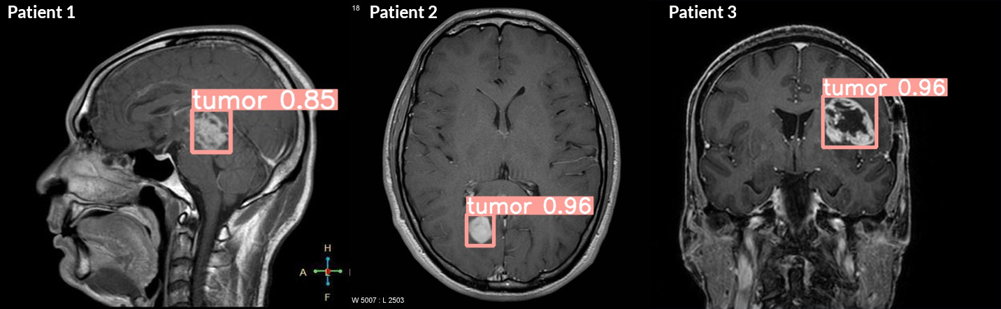 BrainTumorDetection