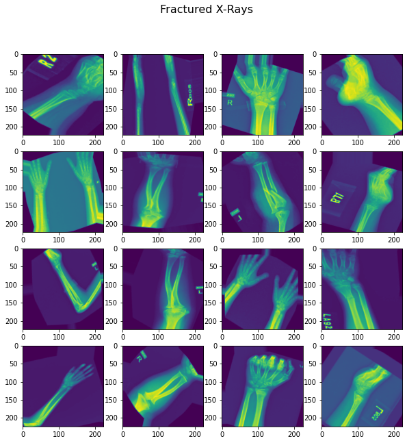 X-Ray_Bone_Classifier