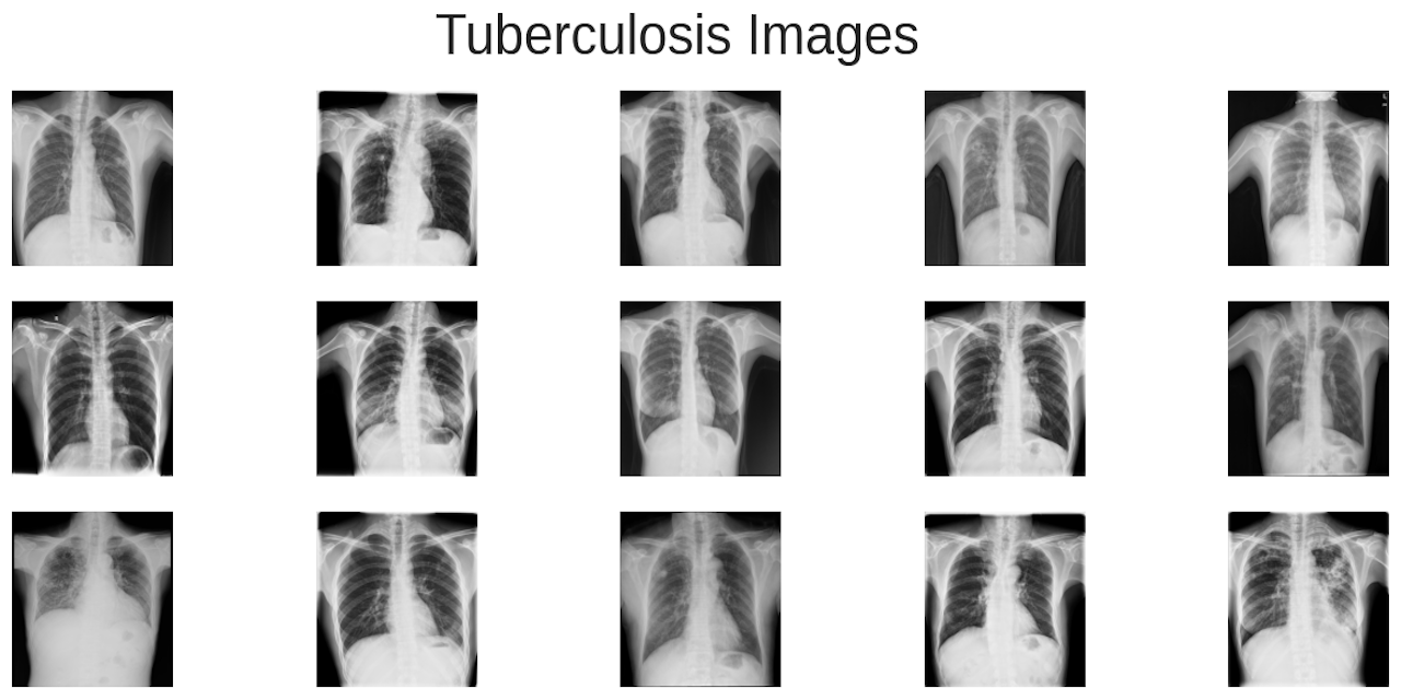 Omdena-Tuberculosis-Image-Classification-Project