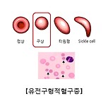 유전구형적혈구증