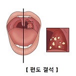 편도결석