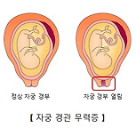 자궁경관무력증