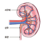 말기 신질환