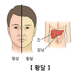 간염