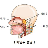 비인두 종양