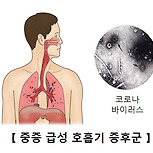 중증 급성 호흡기 증후군