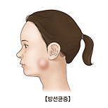 방선균증