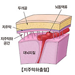 지주막하 출혈