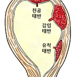 태반 유착증