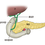 췌장염