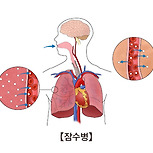 잠수병