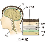 바이러스성 뇌수막염