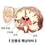 진행성 핵상마비