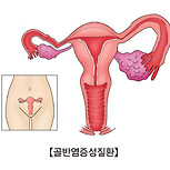 골반 염증성 질환