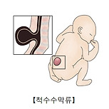 척수소뇌성 운동실조증