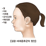 길랑-바레 증후군