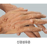 신경섬유종