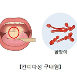 칸디다성 구내염