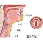 인후두염