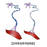 근위축성 측색 경화증