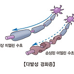 다발성 경화증