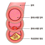 죽상경화증