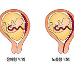 태반 조기 박리