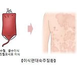 이식편대숙주질환