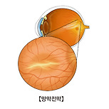 망막 전막