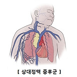 상대정맥 증후군