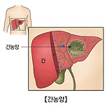 간농양