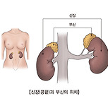 부신암