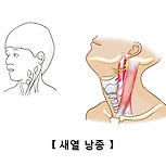 새열 낭종