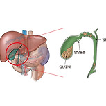 급성 담낭염