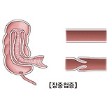 장중첩증