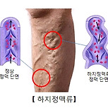 하지 정맥류