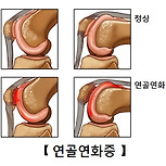 연골연화증